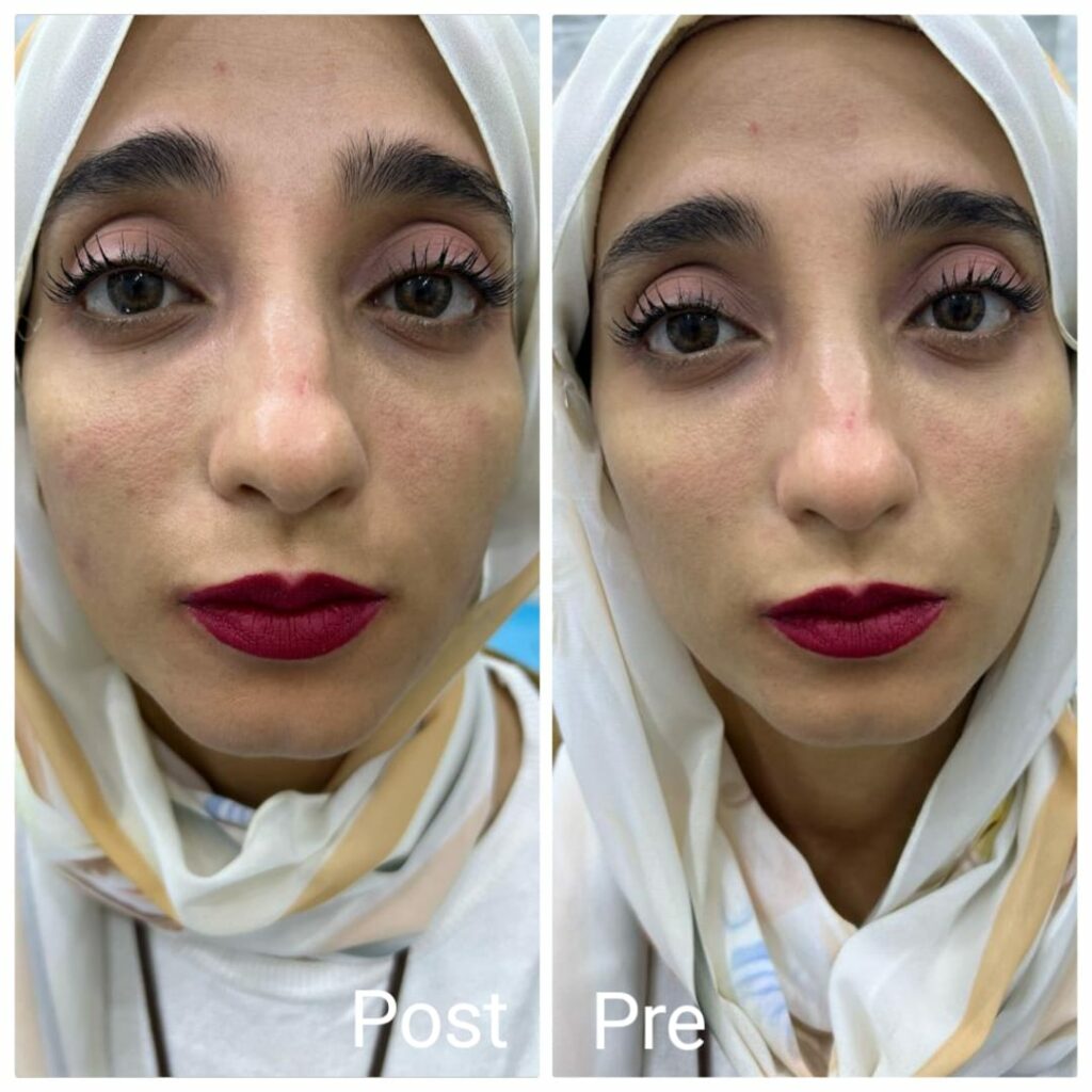 ملئ تجويف أسفل الخدود بالفيلر 1 مل